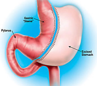 Gastric Sleeve